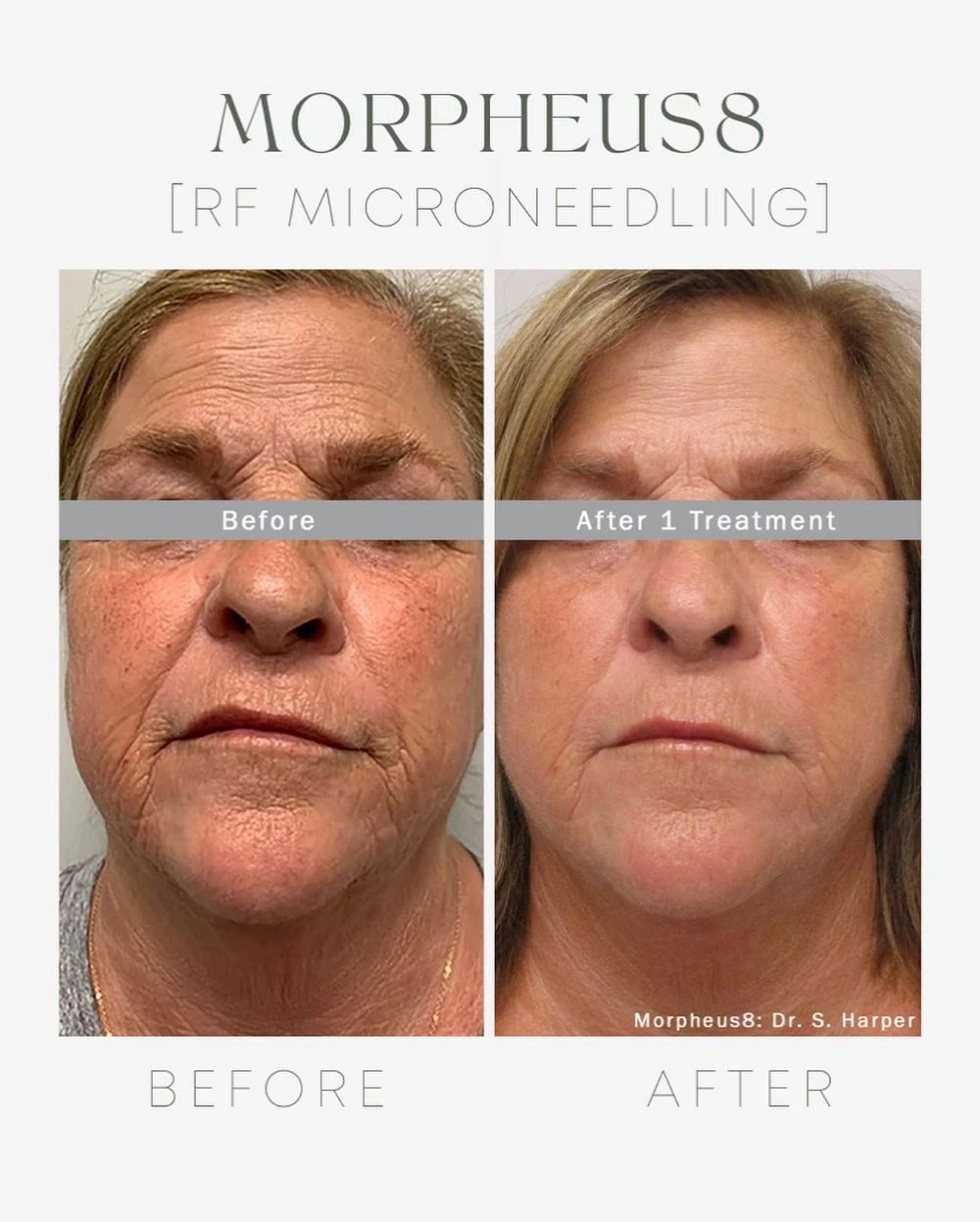 Before and after: Face, after 1 treatment