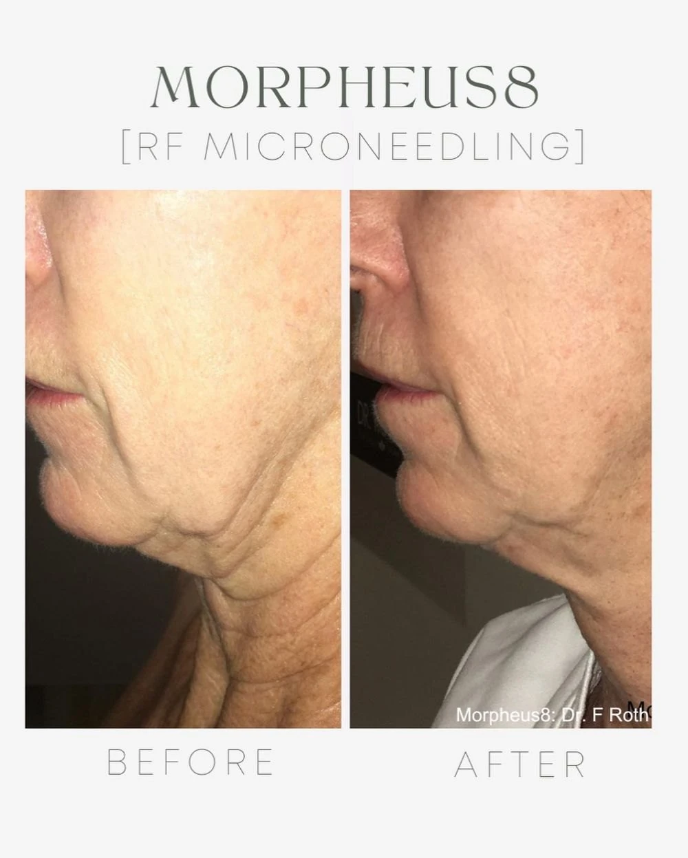 Before and after: Neck and jawline